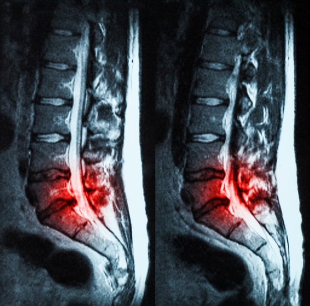 North Carolina Herniated Disc Injury from Car Accident Claim & Settlement